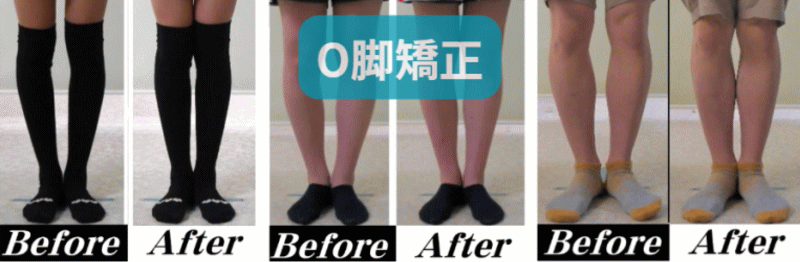 O脚・X脚矯正施術料